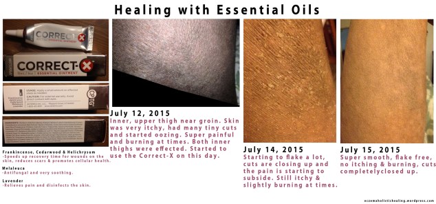 Healing with essential oils - email me for more info about purchasing! eczema.holistic.healing@gmail.com
